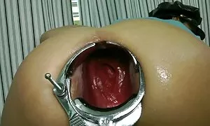 Speculum prolapse ng ...